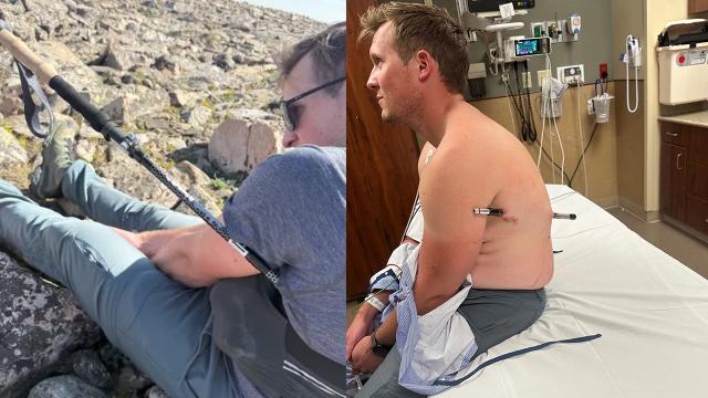 Vücuduna yürüyüş sopası saplanan dağcı 16 kilometre yürüdü haber görseli