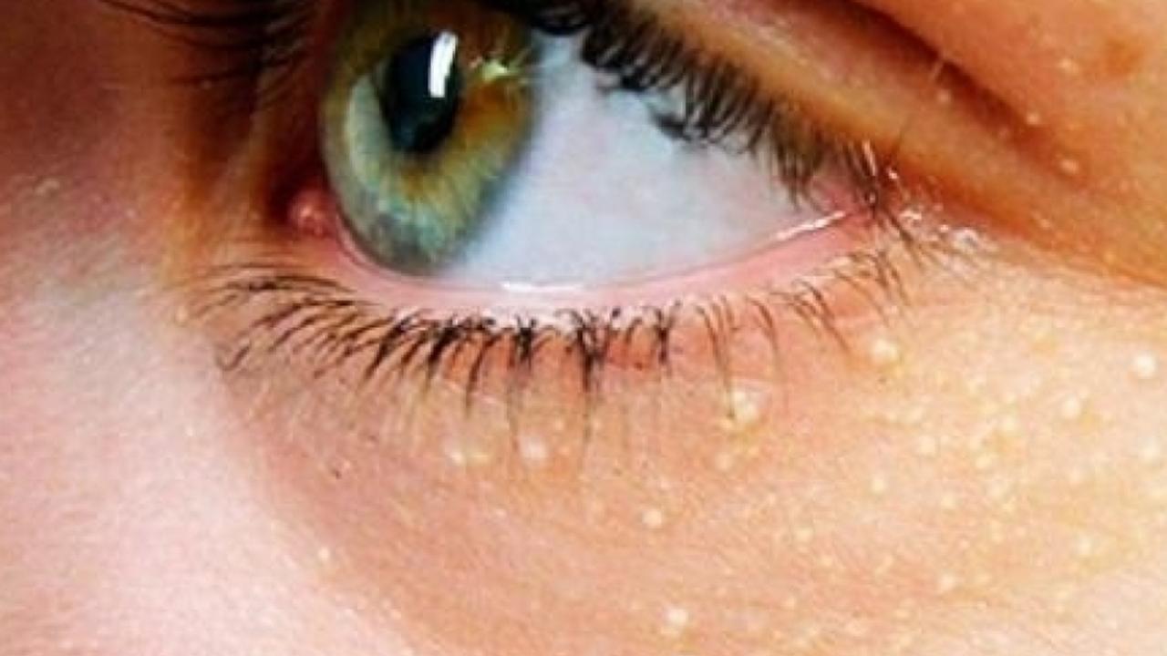 Kalp krizi ve inme riskine işaret eden yüzdeki sarı lekeler: Ksantalazma