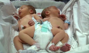 Hatay'da yapışık ikizler dünyaya geldi