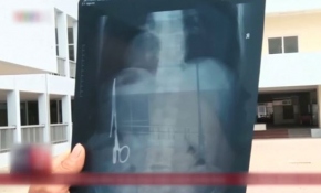 Karnındaki makasla 18 yıl yaşadı