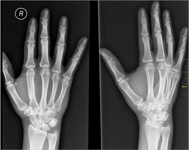 12. X-Ray Işınları