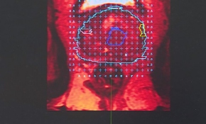 Prostat kanserinde yeni teşhis yöntemi