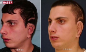 Doğuştan kulakları olmayan Ümit'in artık yüzü gülüyor