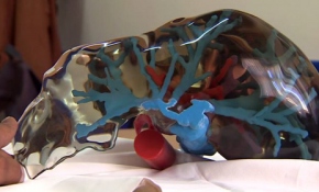 Karaciğer naklinde 3 boyut devrimi