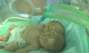 Yapışık ikizler Riyad'da yapılan ameliyatla ayrıldı