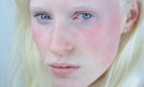 Albinizmlilerin tek farkı pigment eksikliği ile doğmaları