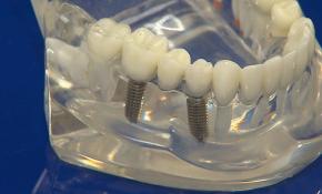 Samsun'da yerli ve milli imkanlarla implant üretildi